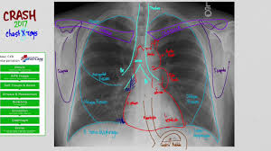 Anatomy of chest x ray. 01 Cxr Anatomy Youtube