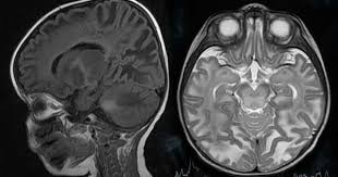 Canavan Disease