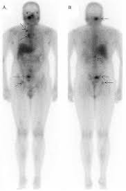 Image result for Extrapulmonary Tuberculosis