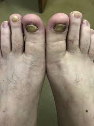 Image result for Onychotillomania feet