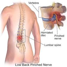 Maybe you would like to learn more about one of these? Herniated Disc Injury After An Accident Lawsuits And Settlements