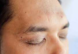 My sister, ellen, also got eczema in her fifties. What Is Dermatitis In The Eyelids Area Oftalmologica Avanzada