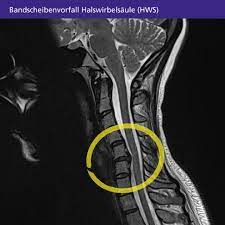 Bandscheibenvorfall Der Halswirbelsaule Hws Symptome Diagnose Und Behandlung Gelenk Klinik De