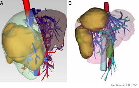 Illustrates distribution of vessels and ducts, duct system with gallstones in common sites, and two views of liver segments. Clinical Evaluation Of Modified Alpps Procedures Based On Risk Reduced Strategy For Staged Hepatectomy Annals Of Hepatology