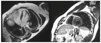 La risonanza magnetica è una tecnica diagnostica che sfrutta i campi magnetici prodotti da un grande magnete, per creare immagini particolareggiate e tridimensionali dell'anatomia interna di una. Revista Brasilia Medica