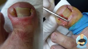 It's normally caused by a bacterium. Extreme Infected Ingrown Toenail Removal Of Deformed Toenail Surgery Youtube
