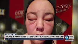 4 why are there no expiration dates on hair dye boxes? Severe Allergic Reaction To Expired Hair Dye Hospitalizes Magna Woman