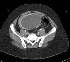 Endometriosis is defined as endometrial glands and stroma that occur outside the uterine cavity. Endometriotic Cyst With Omental Endometriosis Radiology Case Radiopaedia Org