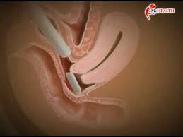 Bacalah dengan seksama dan nikmati juga dengan imajinasi. Myhealth Cara Menggunakan Pesari Dengan Betul Youtube