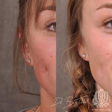Frequent massaging will help in softening the scar tissue and evening out its effect, thereby helping the scar to remain flat on the skin, rather than raised and form a prominent scar that can be difficult to treat. Scar Piercing Mole Removal Before Afters Beverly Hills Center