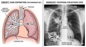 Image result for Atelectasis