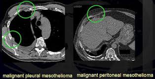 ct scans and mris for mesothelioma analysis. Canadian Ct Lung Screening Tracks Asbestos Workers