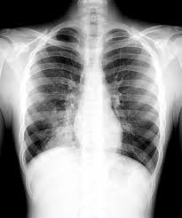 Image result for Pneumonia