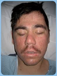 Full article: Characterizing Viral Exanthems