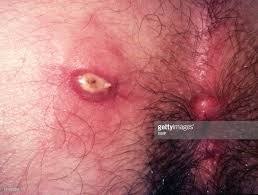 Image result for Perianal Abscess