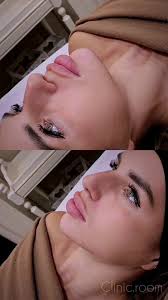 RECEPTIONE al MILANO🇭🇺 📌Giugno, Laregistrazione e aperta a direct🤗,  ✨️Barbie lips👄, 🔥trend 2025🔝, ✨️Russian lips technique, ✨️Lips natural  effect, ✨️Bratz lips, ✨️BotoxFullFace, ✨️Hyperhidrosis , ...