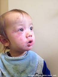 子どものピーナッツアレルギー こういう症状が出ました 写真付きで実際の症例を紹介 ゾンビと呼ばれた赤ちゃん 症例 アレルギー 子ども