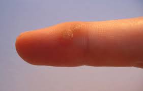 Ketuat plantar disebabkan oleh jangkitan hpv di lapisan luar kulit pada tapak kaki anda. Cara Hilangkan Kutil Ketuat Dengan Mudah Blog Pakej My