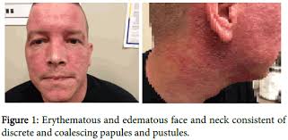 Image result for demodex rosacea