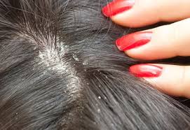 Kepek Sorununa Cozum Home Remedies For Dandruff Beauty Hacks Dandruff Remedy