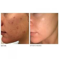 Dr. Dennis Gross Alpha Beta Daily Peel Extra Strength Formula Pack, 1 Pack  (1 x 5 Pieces) : Amazon.se: Beauty