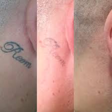 The kind of ink used is also a major factor. The Missing Ink Laser Tattoo Removal Reviews Facebook