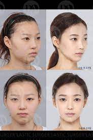 pin on before and after plastic surgery