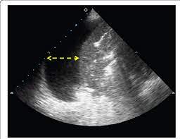 Principles of magnetic resonance imaging. Ultrasound Technique To Measure The Pleural Effusion In Centimeters Download Scientific Diagram