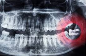 Reverses early gum damage · reverses gingivitis Do You Have To Remove Wisdom Teeth Signs To Look Out For