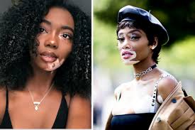 Image result for vitiligo model