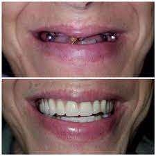 Click on and move the pink sliders on each image to the left and right to see full before and after images. Dentures Partials In Garland Tx Dentures Near Me