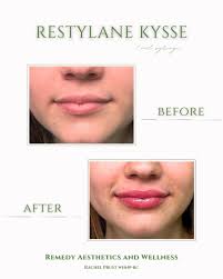 Talk about about a...