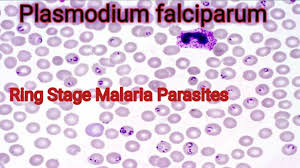 After a successful invasion, malaria parasite plasmodium falciparum extensively remodels the infected erythrocyte cellular architecture, conferring cytoadhesive properties to the infected erythrocytes. Plasmodium Falciparum Under Microscope Youtube