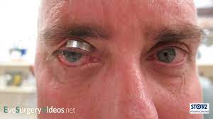 This narrated video demonstrates how to select the appropriate weight for an upper lid gold weight or platinum chain. Sizing An Upper Lid Gold Weight Oculoplastic Eyesurgeryvideos Net