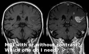 R/o tumor, history of ca, bell's palsy, seizures. Mri With Or Without Contrast Which One Do I Need Omega Pds