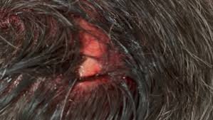 Fundraiser by Dennis Pete Peterson : Please help Pete after his head trauma