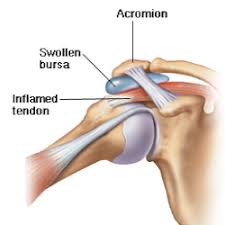 The biceps muscle has tendons on each end of the muscle. Shoulder Tendinitis Causes Treatment Prevention