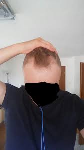 Mithilfe einer haartransplantation lassen sich bei vielen frauen und männern überzeugende ergebnisse erzielen. Haartransplantation Mit 22 Haare Haarausfall Asthetik