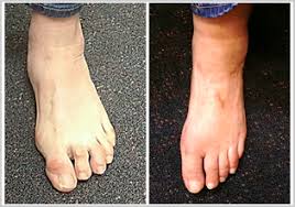 It usually due to compensation in your foot. Hammertoe Treatment Sydney Foot Deformities Treatment Sydney Newtown