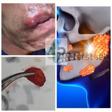 Image result for Sialolithiasis