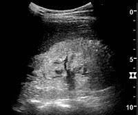 Renal vascular disease affects the blood flow into and out of the kidneys. Chronic Kidney Disease Wikipedia