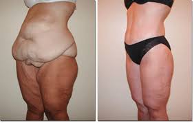 Yourguidetoplasticsurgery Com Body Lift Surgery Mommy Makeover Surgery Skin Removal Surgery