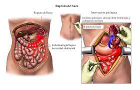 El dolor abdominal en el lado izquierdo no debería descuidarse ni pasarse por alto, dado que es en esta zona donde se localizan órganos como el páncreas, el estómago, el riñón izquierdo, o la parte izquierda del hígado.aquí, puedes descubrir tres variables a considerar: Dolor En El Lado Izquierdo Del Abdomen Embarazo Tos Gases Bajo Y Costado