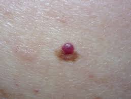 Bleeding can occur if the angioma is. Cherry Angioma Images Dermnet Nz