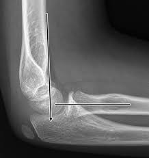 Image result for Elbow XRay