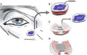 The type of surgery you have depends mainly on the size and location of the tumour. Frontiers Muffin Technique Micrographic Surgery For Non Melanoma Skin Cancer Medicine
