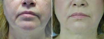 By proper, we mean a. Botox For Marionette Lines Elanamie Clinic
