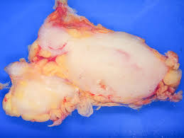 El linfoma es un cáncer de glóbulos blancos llamados linfocitos b o células b. Linfoma Definition And Synonyms Of Linfoma In The Spanish Dictionary