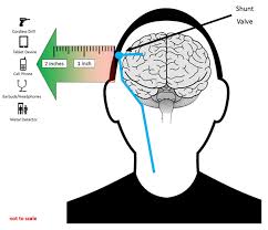 Magnetic Field Interference With Programmable Csf Shunts Fda
