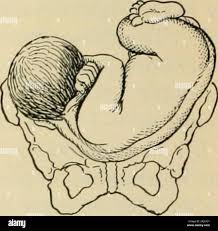 Image result for Shoulder Presentation